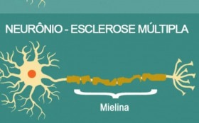 Esclerose múltipla afeta 40 mil brasileiros e atige principalmente mulheres jovens, na faixa de 20 a 40 anos 