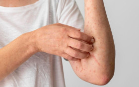 S&atilde;o Paulo confirma segundo caso importado de sarampo