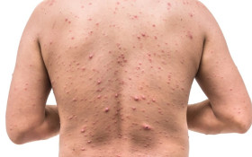 Herpes‑z&oacute;ster pode atingir uma em cada tr&ecirc;s pessoas e &eacute; mais comum ap&oacute;s os 50 anos