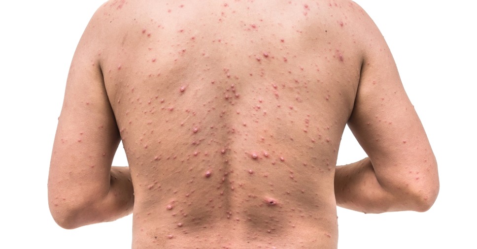 Herpes‑z&oacute;ster pode atingir uma em cada tr&ecirc;s pessoas e &eacute; mais comum ap&oacute;s os 50 anos