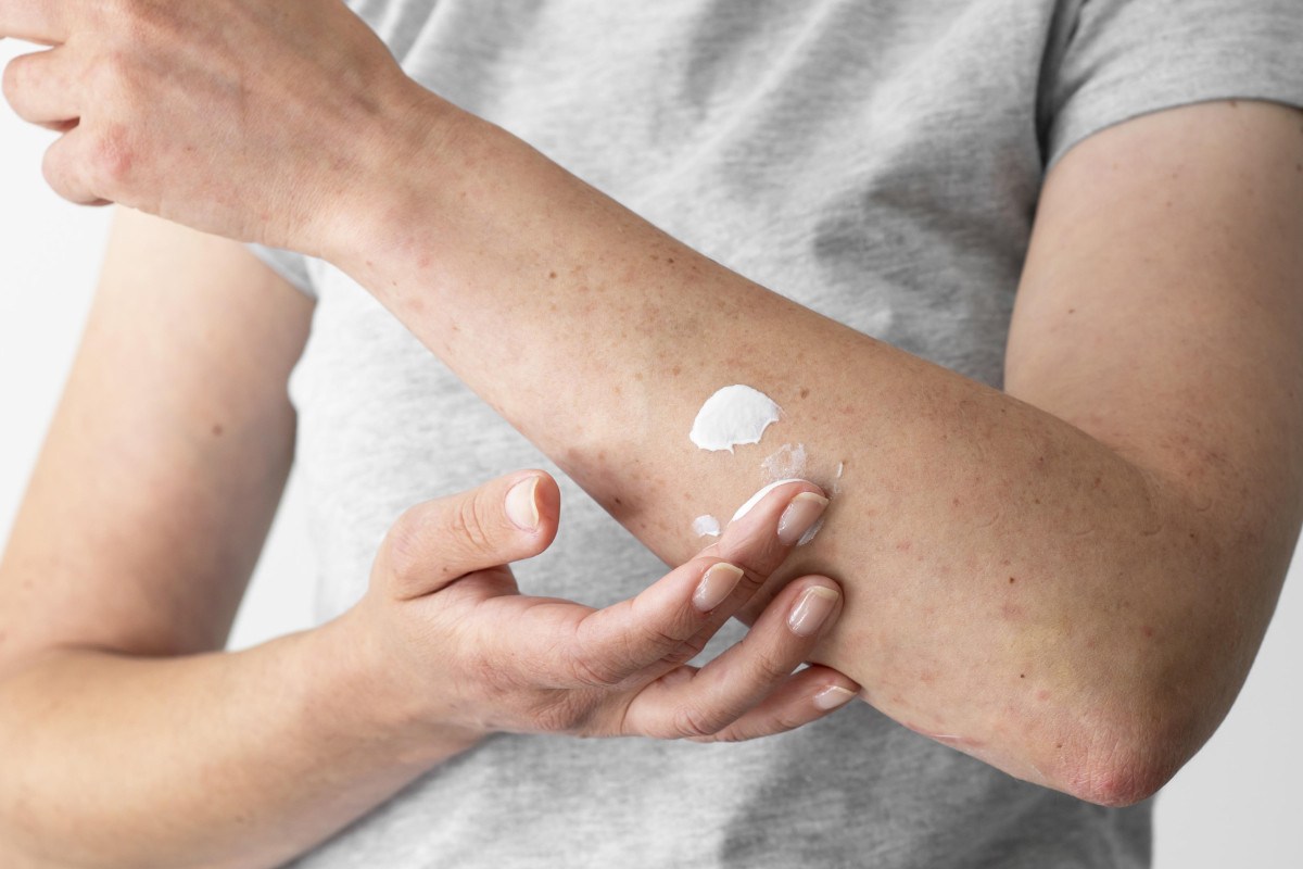 Dermatite at&oacute;pica impacta pele, sono e autoestima