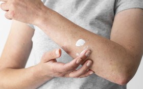 Dermatite at&oacute;pica impacta pele, sono e autoestima